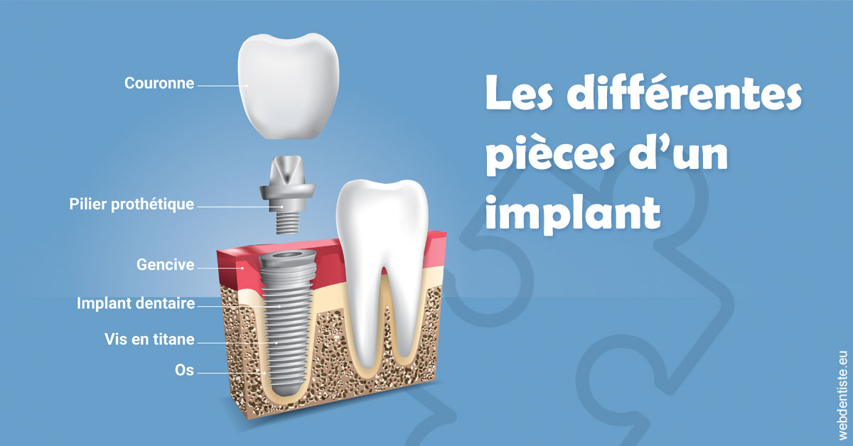 https://www.pedeboscq-pecastaing.fr/Les différentes pièces d’un implant 1